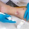 Idrosadenite suppurativa, quando fare la doccia o dormire diventano ostacoli