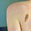 Melanoma, la firma mutazionale del cancro potrà cambiare la cura﻿